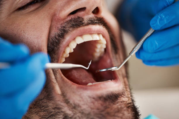 Best Emergency Dental Care for Abscessed Tooth in Rancho San Diego, CA